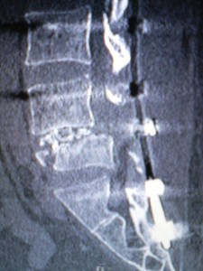 第五腰椎CT画像